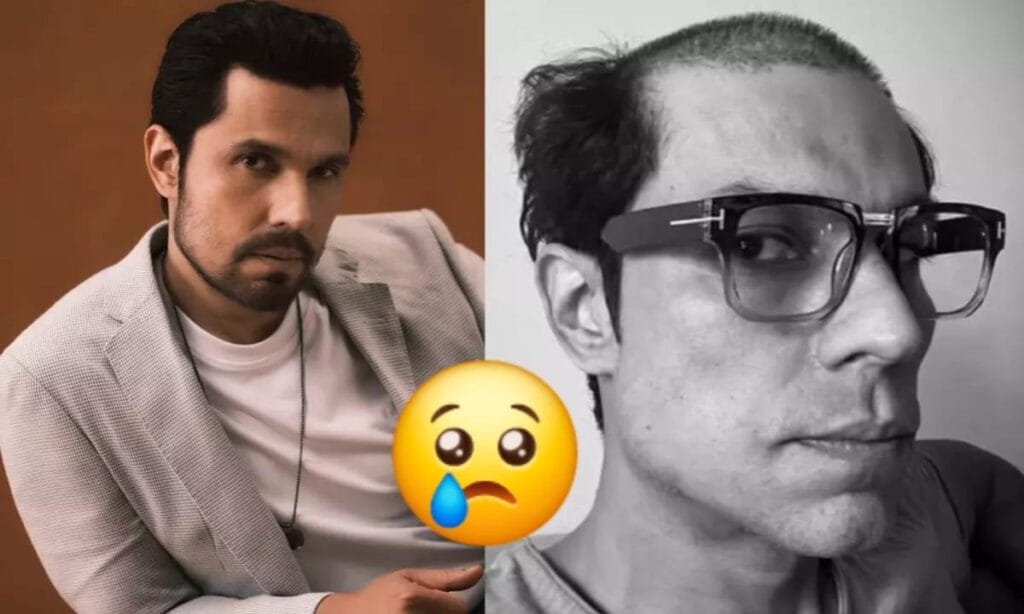 Randeep Hooda Hair loss