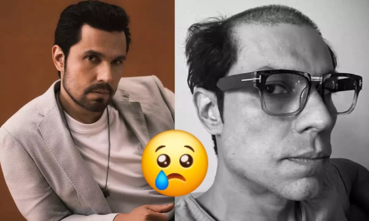 Randeep Hooda Hair loss