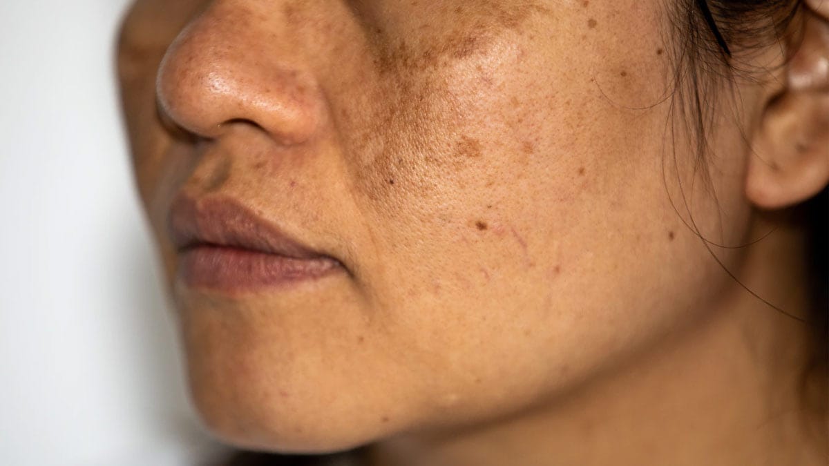 jhaiyan-ke-lakshan-face-dark-spots-freckles jhaiyan-ke-lakshan-face-dark-spots-freckles